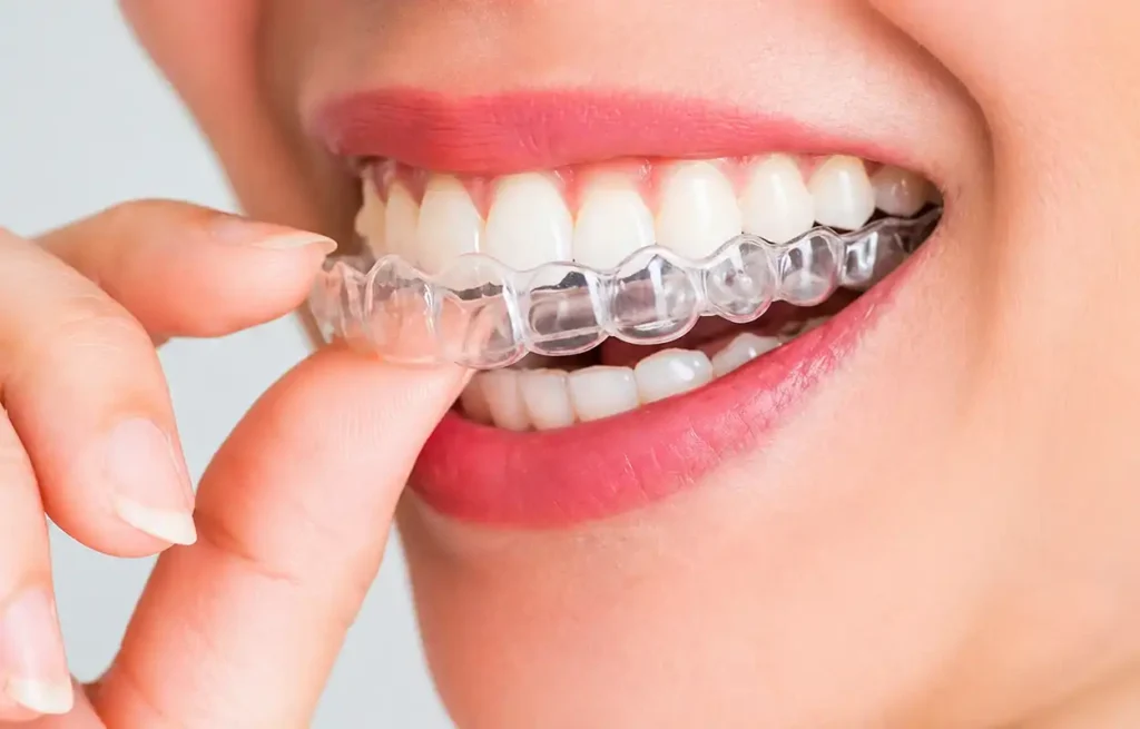 Imagem em close-up de um sorriso saudável, onde uma pessoa posiciona um alinhador transparente nos dentes superiores. O dispositivo odontológico, praticamente invisível, se ajusta perfeitamente à arcada dentária, evidenciando um tratamento moderno, discreto e eficaz para alinhamento dos dentes e proteção contra o desgaste dental, como no caso do bruxismo. A cena transmite cuidado com a saúde bucal, estética e tecnologia avançada na odontologia.